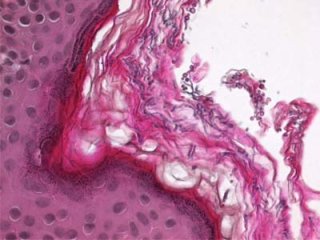 Проверенные народные рецептов от отрубевидного лишая