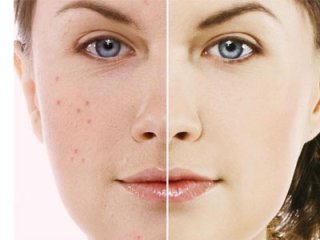 Народные средства от угрей