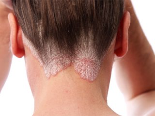 Эффективные рецепты против чешуйчатого лишая подскажет народная медицина