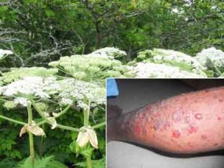 Если от борщевика случился ожог, народный рецепт излечиться помог