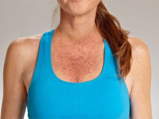 Пузырчатка и народные средства. Кто победит?