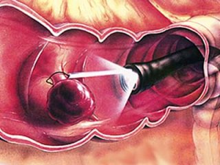 Травы — лучшие помощники от полипов в кишечнике