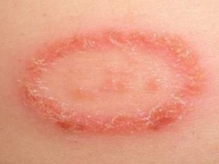 Проверенные народные средства лечения и профилактики лишая