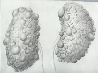 При поликистозе почек народные средства в дополнение к основному лечению