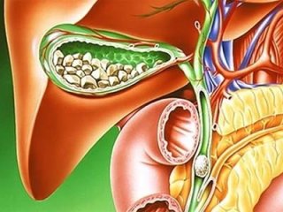 Как лечить калькулезный холецистит народными средствами
