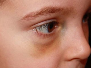 Синяк или ушиб — не помеха народным рецептам