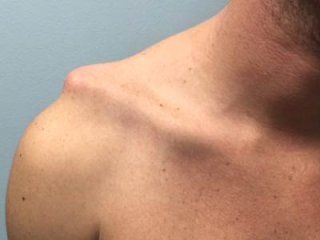 Что делать, если случился вывих