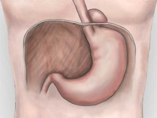 Как избавиться от грыжи желудка народными средствами