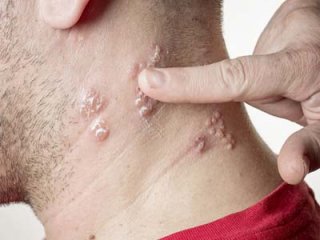 Розовый лишай и его лечение средствами народной медицины