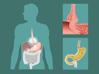 Народное лечение диафрагмальной грыжи пищевода