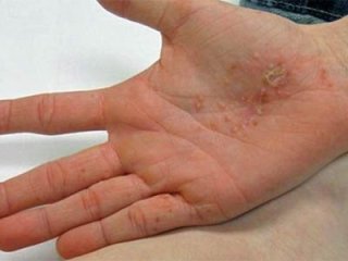 О том, как можно лечить дисгидротическую экзему народными средствами
