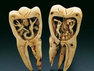 Народные средства при лечении зубов