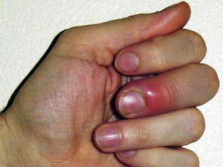 При панариции пальца помогут народные средства